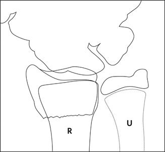 Fracture_Distal radius physeal_Figure 3_1370609-Salter-Harris2_AP_drawing.jpg